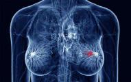 导致乳腺癌的8大常见诱因 女性不可不防