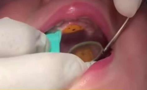 西安一岁女童嘴里藏“贴画” 2周后发现口腔已受伤