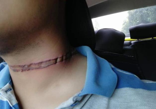 西安男子晚上回家时被悬空的电线勒住脖子 留下约10厘米长的勒痕