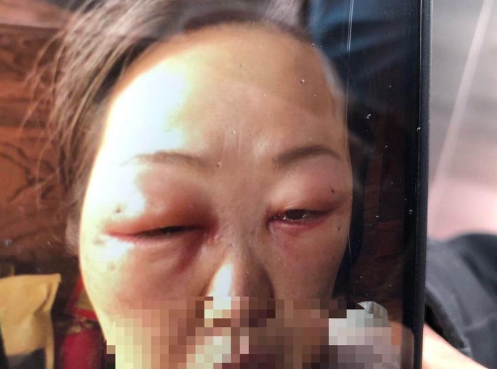 西安53岁女子祛除眼袋后面部肿胀 医院称可能是急性水肿