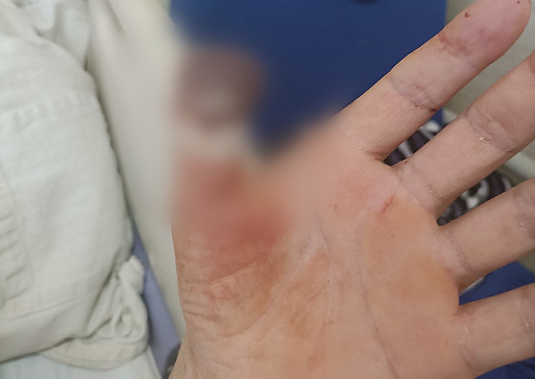 西咸新区一男子工地干活锯掉大拇指 住院3月未获理赔出院难