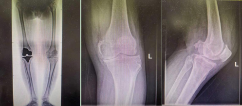 体重200斤的患者又来了 要求置换另一个膝关节