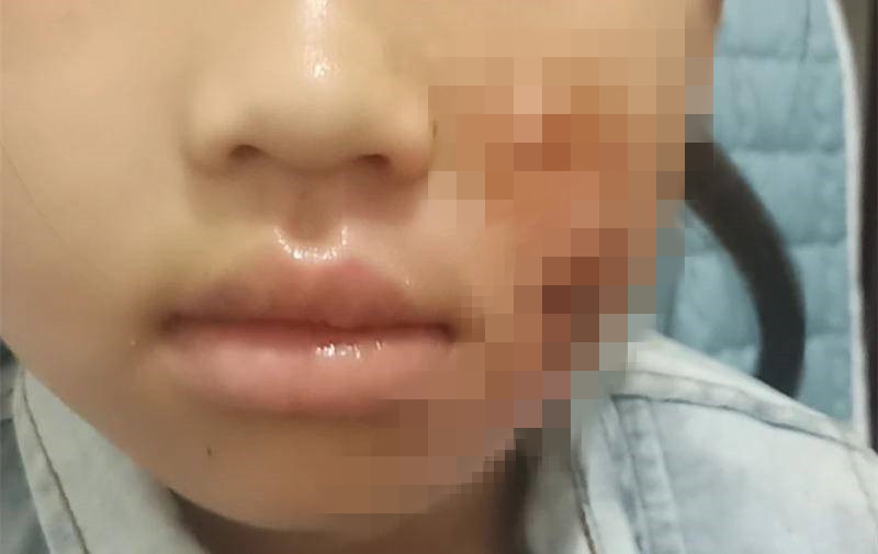 家长当心！西安9岁女孩用吸管杯喝水时脸唇都被热蒸汽烫伤