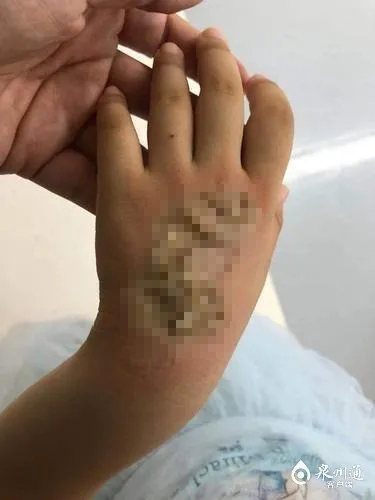 孩子的手背皮肤被严重烧伤，为三度烧伤。