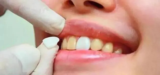 美容店“美牙师”如此速成？当心“美牙”变“毁牙”