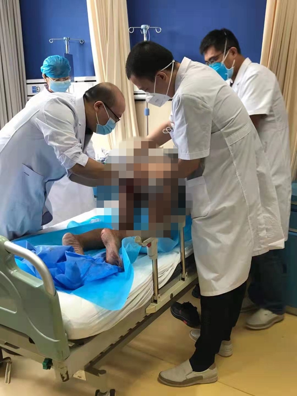 陕西省结核病防治院救治一例罕见重度“脱肛”患者