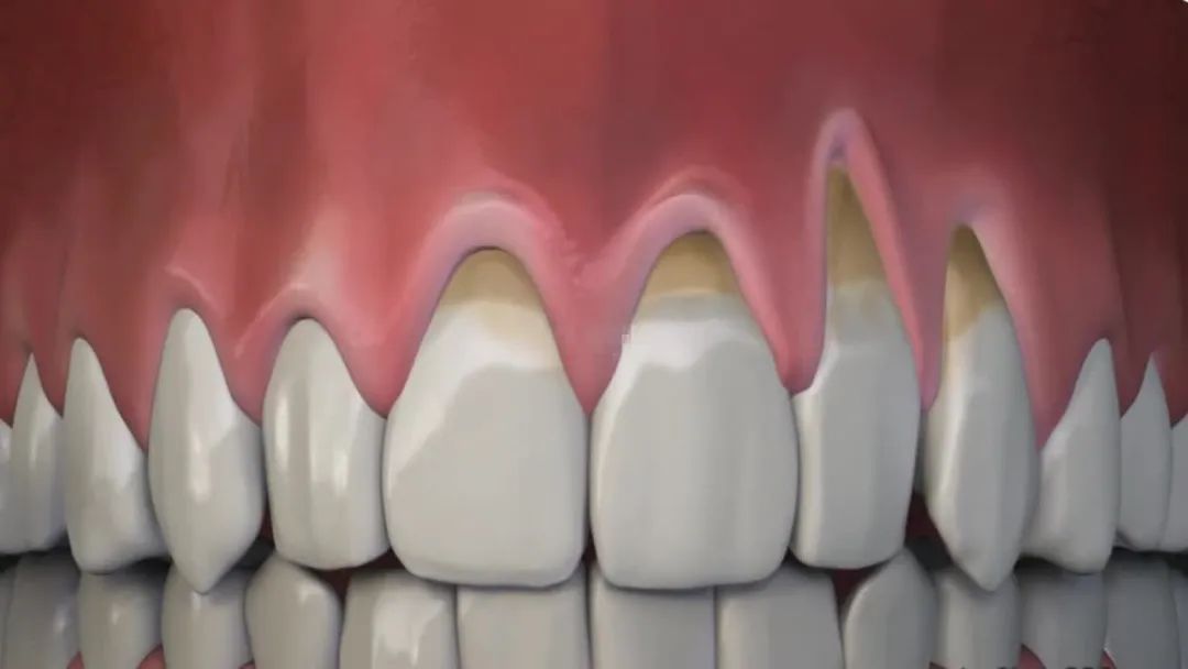 我们口腔里的牙结石总是不经意间越来越多,而牙龈就像是脑门上的头发
