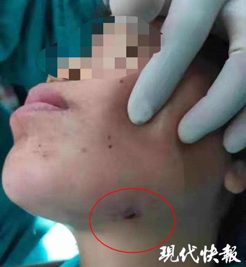 扬州女子智齿反复发炎靠吃消炎药硬扛 导致脸颊烂穿一个洞