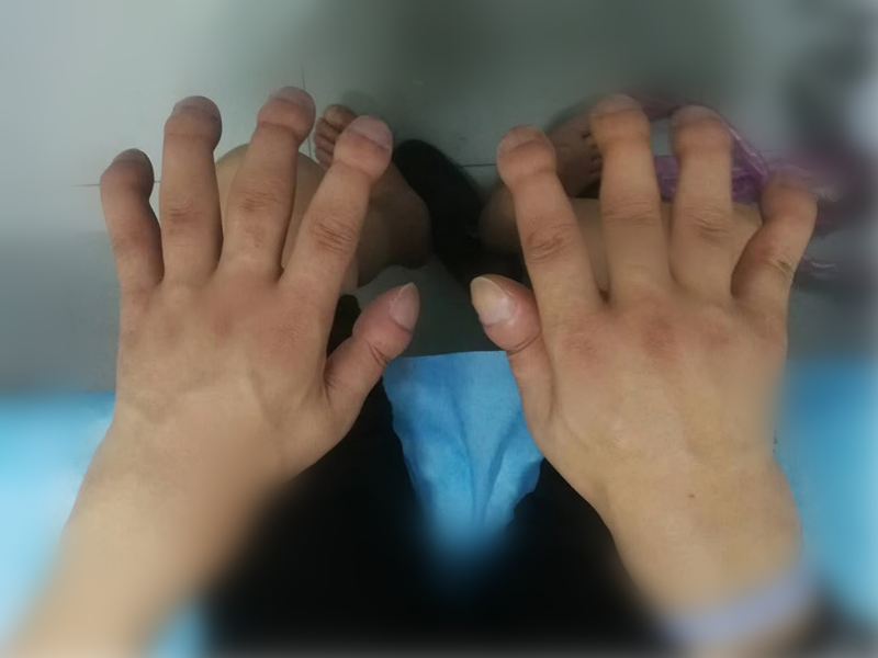 西安市第五医院释疑：您见过这样的手和脚吗？