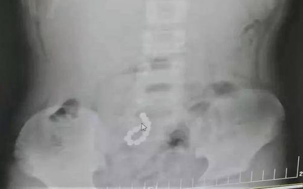 危及生命！西安8岁男童吞下12颗磁力珠致小肠9处穿孔