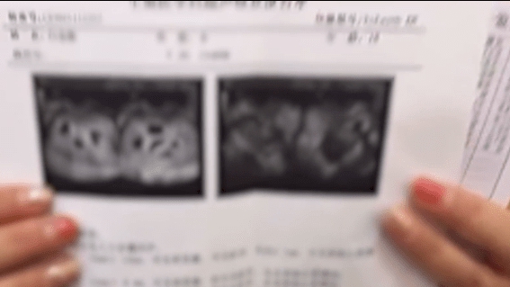 郑州18岁女子怀8胞胎：因不规范使用排卵药物 暂不公布是否减胎