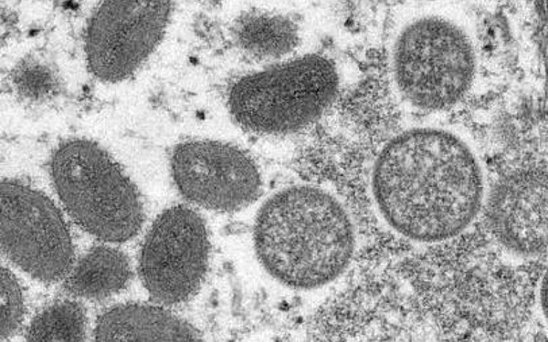 美国专家警告：猴痘疫情在美国有失控风险