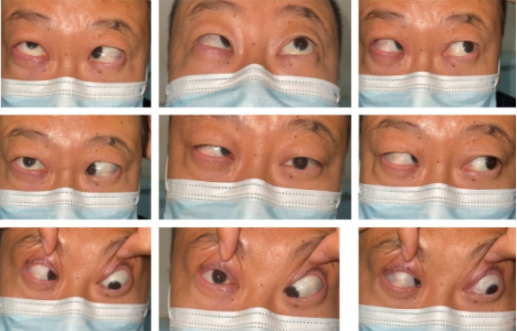 西安市第一医院小儿眼科完成罕见眼外肌手术