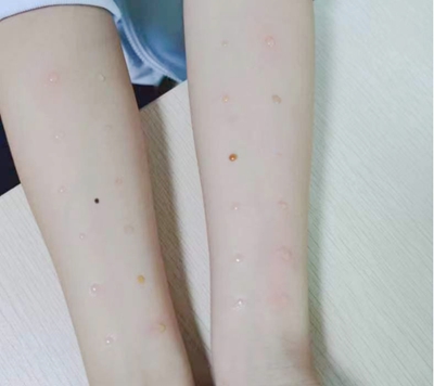 当开学季遇到过敏季