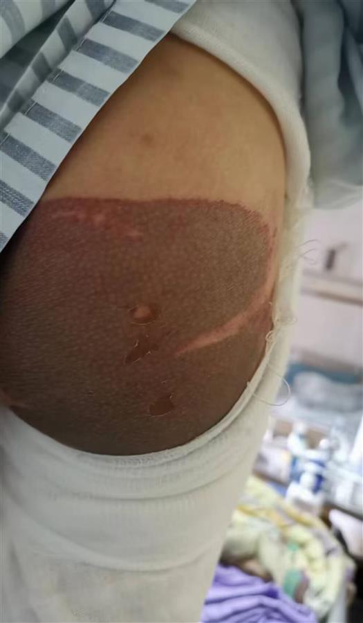 广州地铁上小男孩被硫酸滑倒灼伤 警方：系刑事案件，嫌疑人已抓获