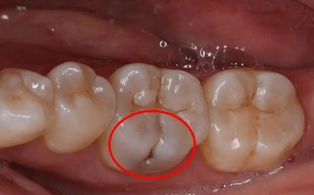 牙齒齲壞醫生教你如何應對?