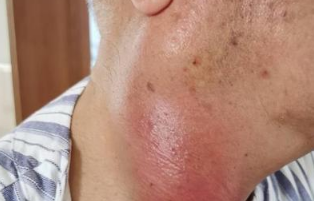 西安一老人被诊断出腮腺囊肿 医生：颈部异常要尽快就医