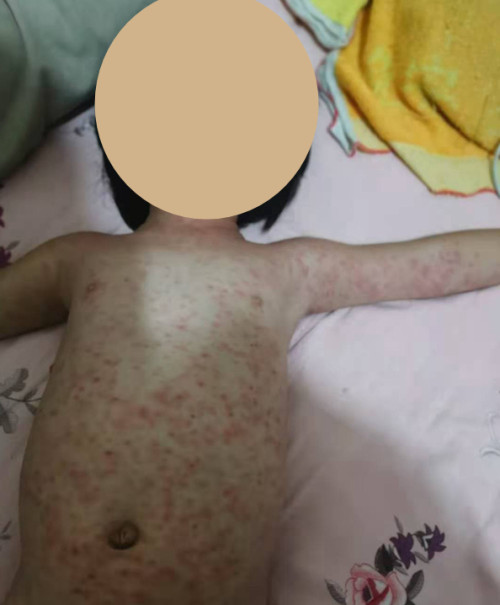 华商头条|打四价流感疫苗后 商洛3岁女童出现药疹一个多月不退