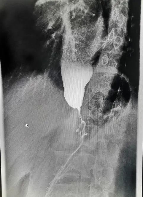 西安市第三医院经口内镜下食管括约肌切开术帮助患者解决吞咽困难难题