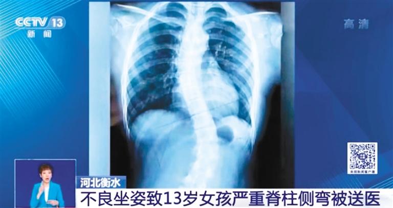该如何防治？中小学生脊柱侧弯人数已超500万 
