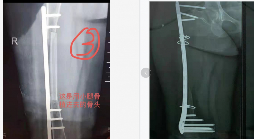 “女子骨头持续消失”确诊为特发性骨溶解症：是一种罕见病