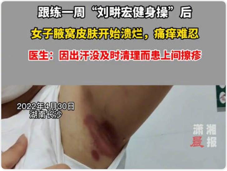 长沙27岁女子跟刘畊宏跳操不洗澡致腋窝溃烂