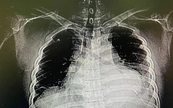 36岁男子自行针灸时针头遗留体内 3个月后心脏被扎破