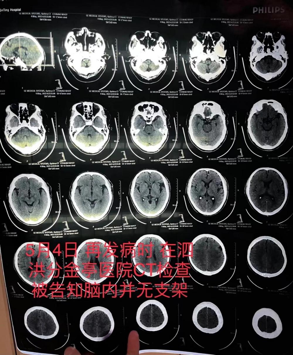 江苏一患者因脑梗去世 医生承认支架植入失败并隐瞒