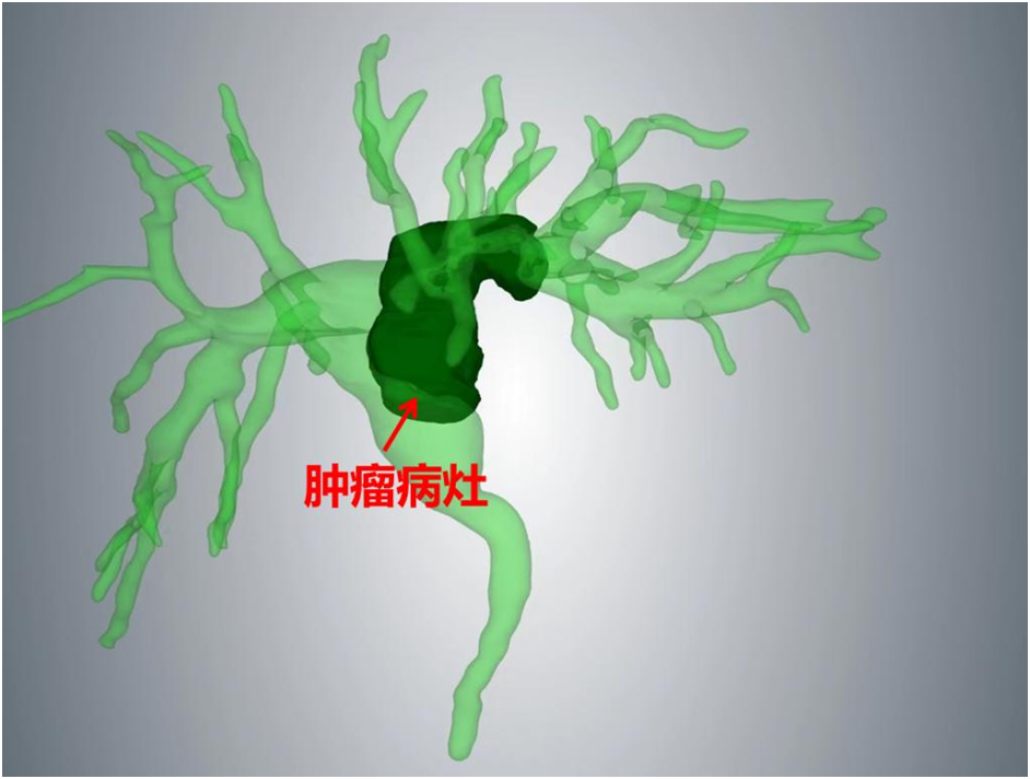 华商头条|二附院移植外科、感染科等多学科协作完成全腹腔镜下肝门部胆管恶性肿瘤根治术