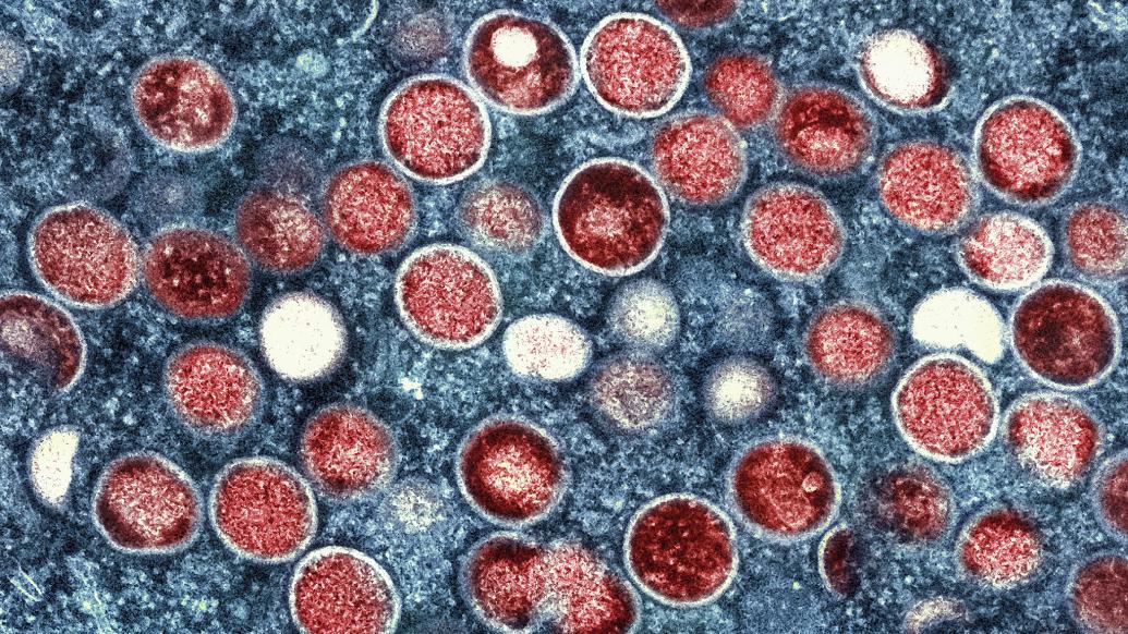 中国首次报告5例女性猴痘病例 “可能出现家庭内传播”